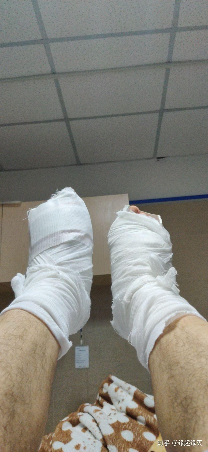 包含JJJ正式接受脚趾手术三个月后重新评估的词条